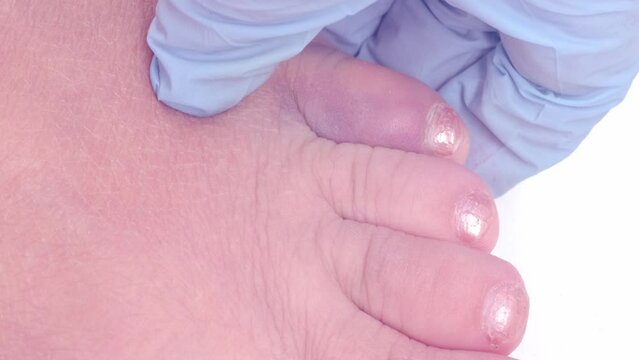 traumatologist examines injured little toe, concept of fracture, bruise, redness in area of injury, soft tissue edema, pain on palpation, industrial or domestic injury
