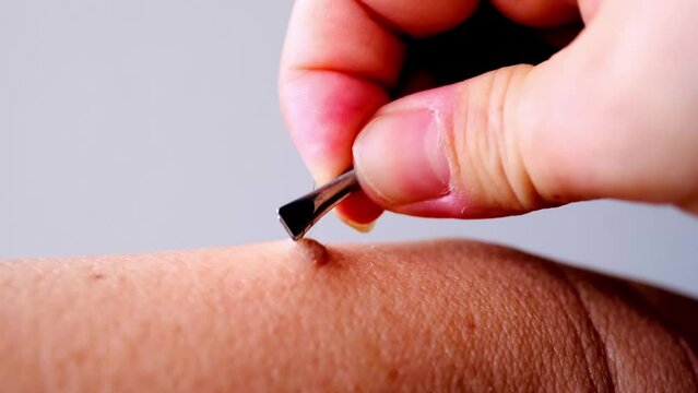 close-up female hand plucks hair from wart with tweezers, skill and precision required for using metal tweezers to remove excess hair effectively and safely