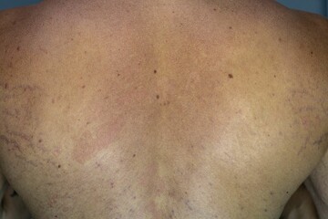 Man suffering from the skin condition Tinea Versicolor with discolored patches on the skin