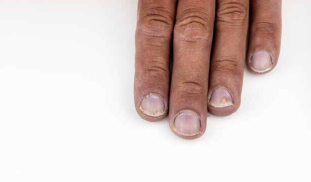 Close-up of a fingers with Psoriatic onychodystrophy against a white background