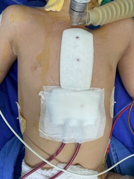 Closed up to sternotomy covered by gauze and site of mediastinum drain and pericardial drain for medical and technology concept