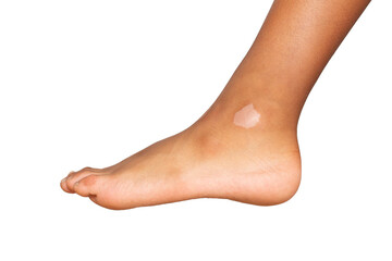 Vitiligo spot on a child's foot