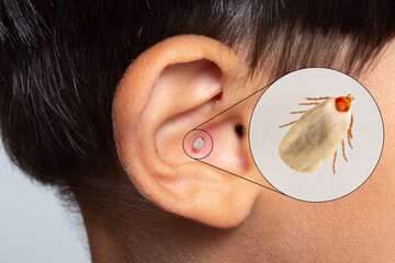 Tick attached to a child's ear. Dangerous disease transmission concept