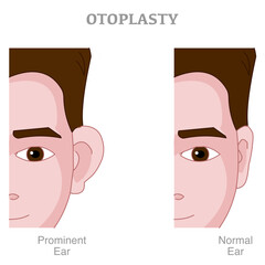Prominent ear, otoplasty correction surgery. Plastic operation. Male before after. Asymmetry big ear problem, reshaping. Cartilage, Face design. Medical Illustration vector