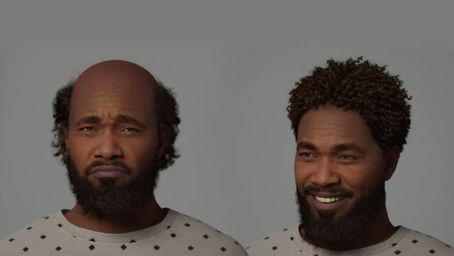 African American man hair transplant.
Unhappy bald man gets a hair transplant and is now happy