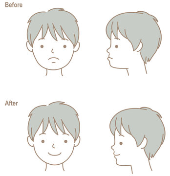 反対咬合のこどもの顔、歯科矯正のビフォーアフター