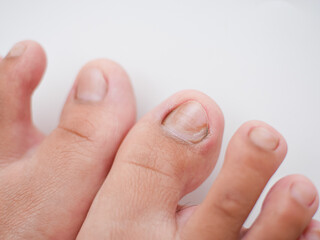 Toes with nail disease isolated on a white background