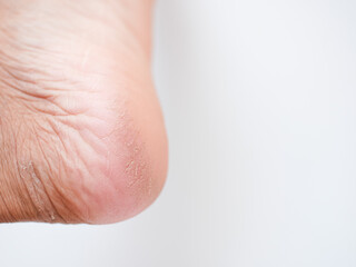Dry and cracked soles of feet on a white background. cracked skins