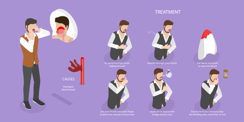 3D Isometric Flat Vector Conceptual Illustration of Nose Bleeding, Causes and Treatment