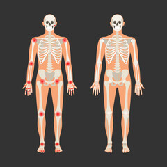 Human skeleton with pain points in rheumatoid arthritis. Men anatomy illustration with a body silhouette. Vector isolated flat of skull and bones in body - obrazy, fototapety, plakaty