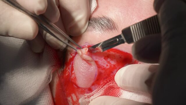 Eyelid Surgery Scalpel Cut Skin 1