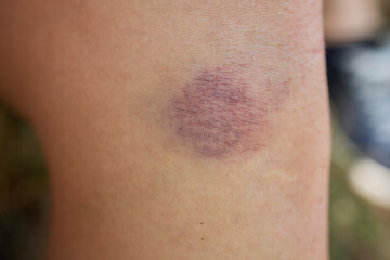 Bruise on the leg of a woman. A bruised leg. Close-up.
