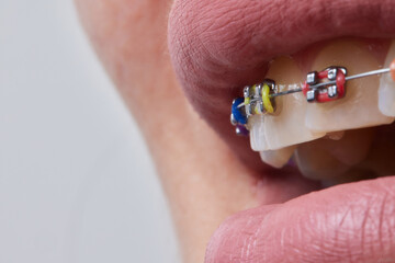 Dental procedure for installing braces close up.The procedure for the care of teeth and gums in the...