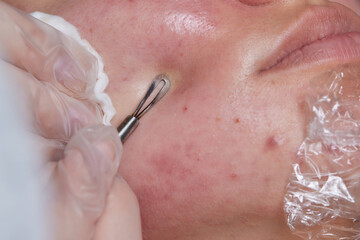 Mechanical facial cleansing, skin cleansing procedure from surface and deep impurities. new.