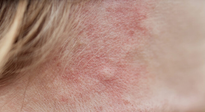 Bite mark, sting or sore on human skin. Close up of symptoms. Healthcare theme.