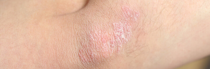 Dry itchy skin on the elbow area close up.