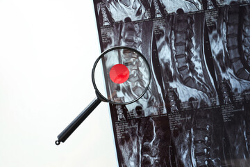 MRI or magnetic resonance imaging of the spine of a person with a lens and detected pathology.