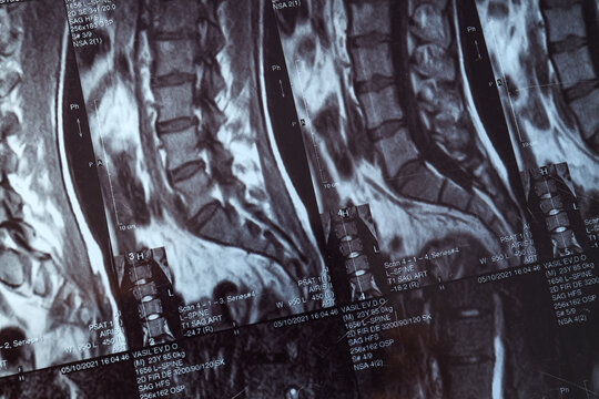 MRI or magnetic resonance imaging of the human spine. Close-up