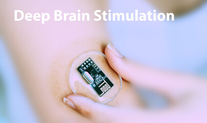 Deep Brain Stimulation Implantable Electronic Medical Devices Concept