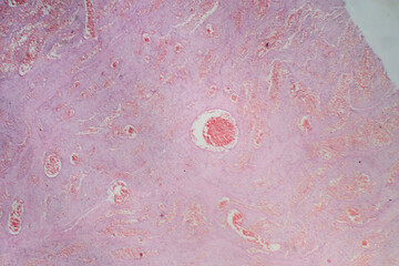 Capillary hemangioma, light micrograph
