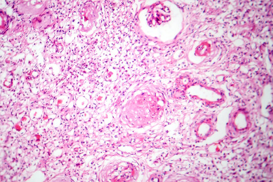 Primary particulate contracted kidney, light micrograph