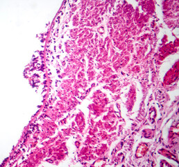Chronic bronchitis, light micrograph