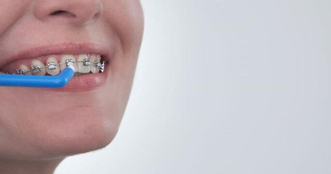 Cleaning orthodontic braces with mono brush, close up. Advertisement copy space. Woman brushing braces with toothbrush on white background. Beautiful white brackets smile. Dental health hygiene