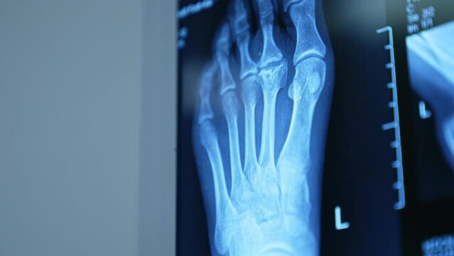X-ray scan of a patient's foot in two projections. Close up. Preparation for the orthopedic surgery.