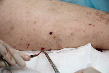 Close up of doctor with the help of surgical forceps removes the varicose node on the patient's...