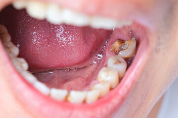 Tooth's a man smoking bad. woman smokes a cigarettes have tooth decay and calculus on teeth, So we should be care dental with the hygiene