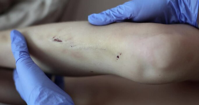 Doctor treats healing burn wound on child leg. Children and redness scarring of skin concept of medical care human tissue regeneration
