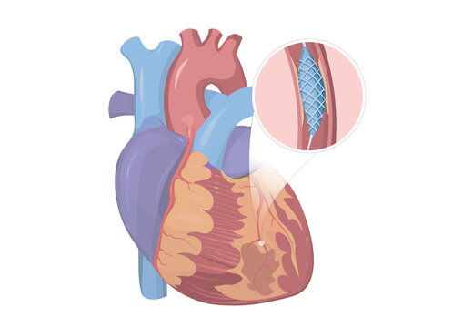 Human heart with stent, illustration