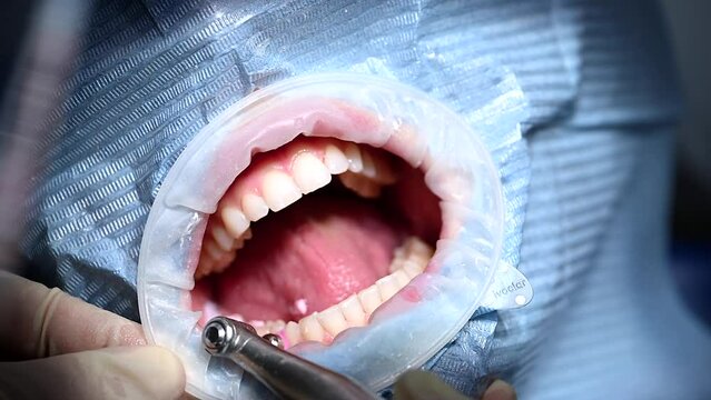 Dental Extreme Close up Macro Video. Dental Cleaning process in patient mouth. Clean teeth with water jet and saliva ejector. Concept of professional dental hygiene. 4k 120 fps slow motion raw footage