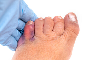 traumatologist examines injured little toe, concept of fracture, bruise, redness in area of injury,...
