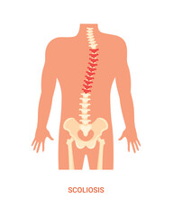 Human Posture Design Vector of Scoliosis Diagnosis
