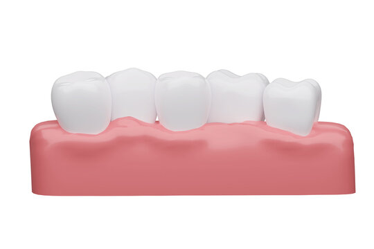 overlapping teeth with gums isolated white background, 3D rendering.