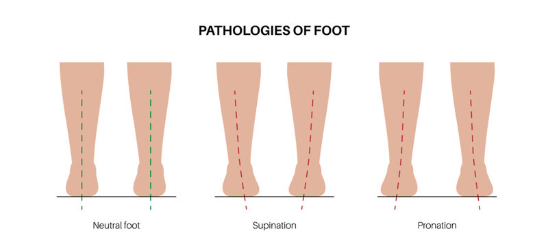 Pronation, overpronation and supination