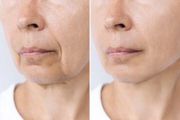Lower part of elderly woman's face and neck with signs of skin aging before after facelift, plastic...