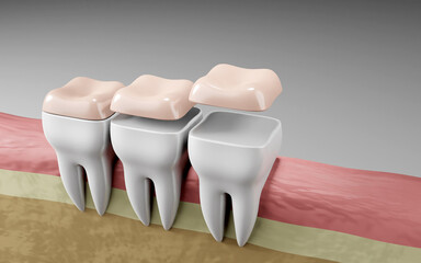 teeth onlays dental filling, Oral health and dental inspection teeth. Medical dentist tool, children healthcare, 3d render