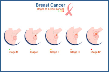 Medical illustration vector concept,female breasts and four levels of breast cancer severity.isolated on white background,flat style.