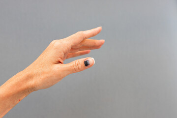 Subungual hematoma present under the toenail of the hallux, more commonly known as the nail broken...