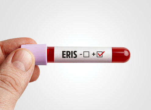 EG.5.1 a.k.a. Eris variant concept: Scientist holding Eris, a descendant of XBB.1.9.2, infected blood in test tube on white background.