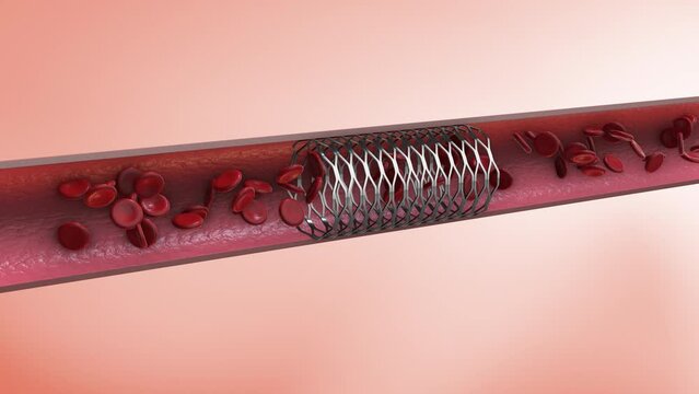 Implantation of a coronary stent