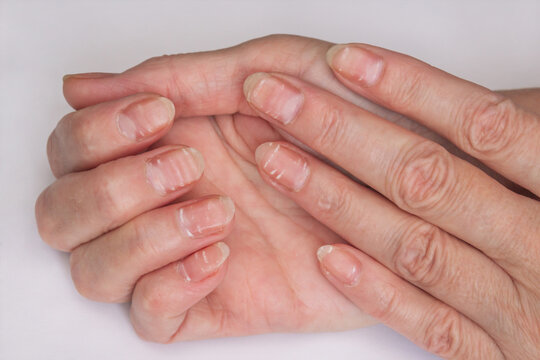 close-up photo of female age-related hands with white stripes on the nails from lack of vitamins