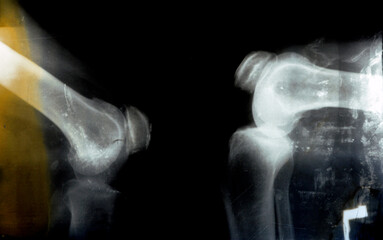 Old retro Plain X ray of the right knee shows apparent joint osteoarthritis by Kellgren and...
