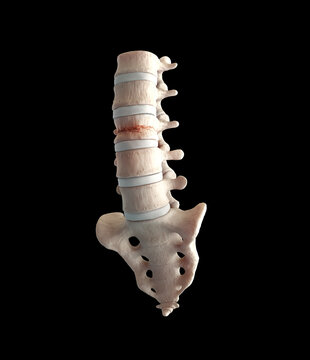Lumbar compression fracture injury on black background