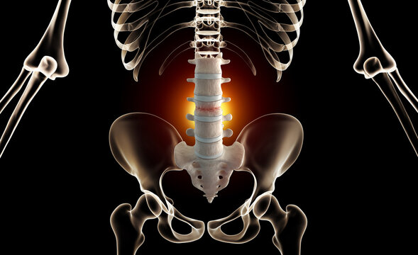 Lumbar compression fracture injury on x-ray skeleton
