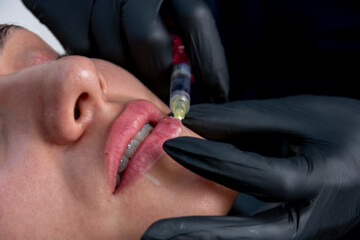 closeup to the lips of a young woman who is being injected with hyaluronic acid