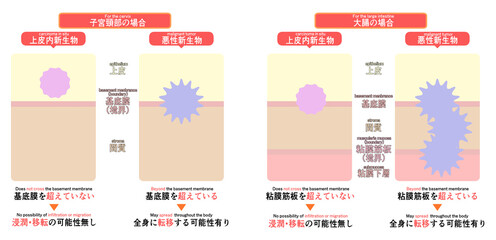 上皮内新生物と悪性新生物の違い