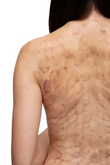 Young woman with hematoma after a session of vacuum cans isolated on white background. Back alternative treatment. View of a back after acupressure close up.